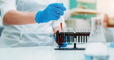 PRRT (Peptide Receptor Radionuclide Therapy) Image